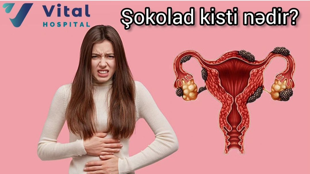 Şokolad kisti
